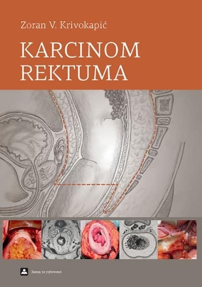 Karcinom rektuma